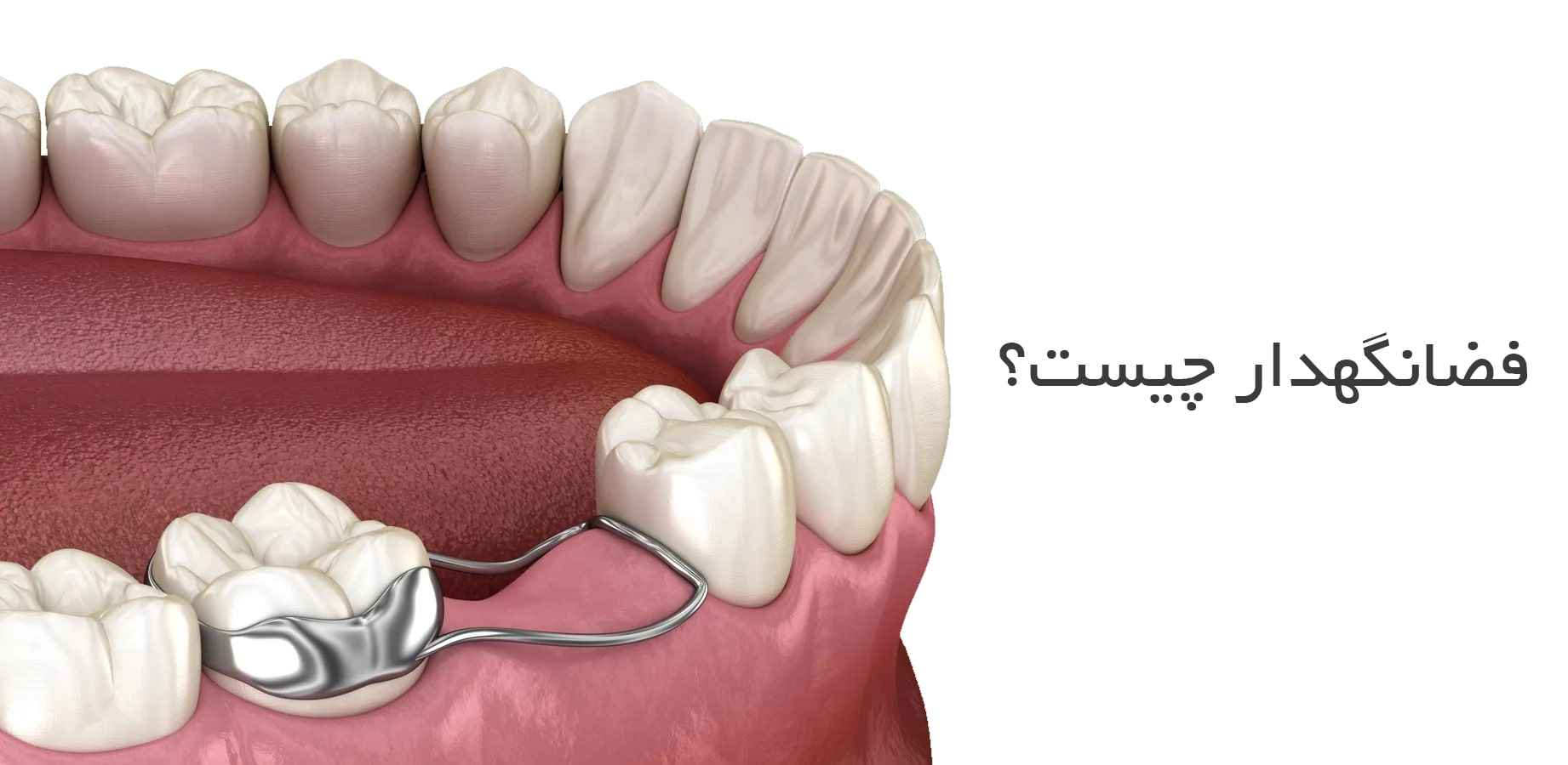 راهنمای جامع استفاده از فضا نگهدار ارتودنسی