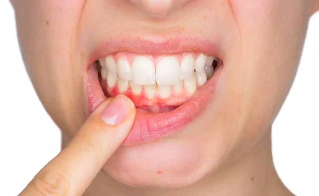 چگونه لثه های سالم تری  داشته باشیم؟